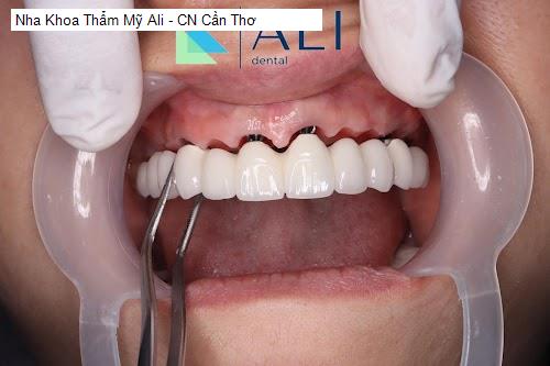 Hình ảnh Nha Khoa Thẩm Mỹ Ali - CN Cần Thơ
